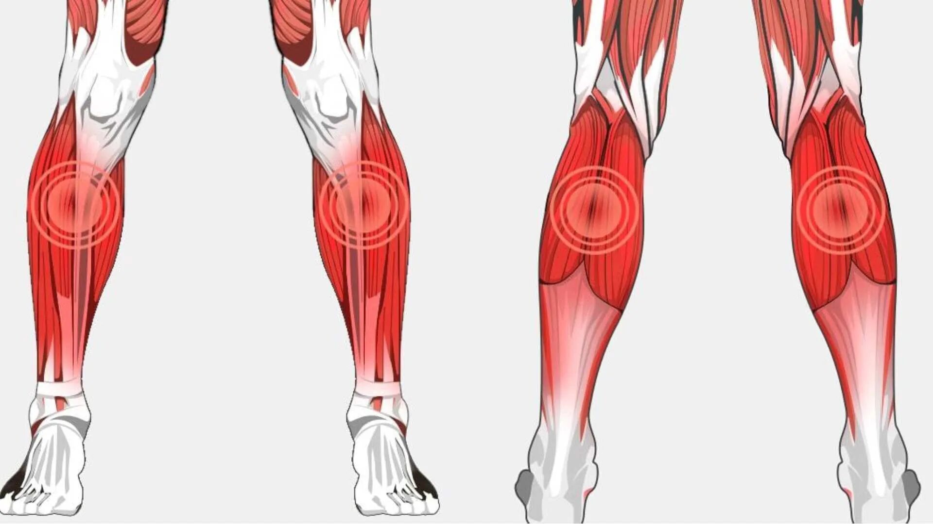 Сильная боль в икрах ног. Вены икроножной мышцы анатомия. Миозит камбаловидной мышцы голени. Ноги боль икроножная мышца. Варикоз икроножная мышца.