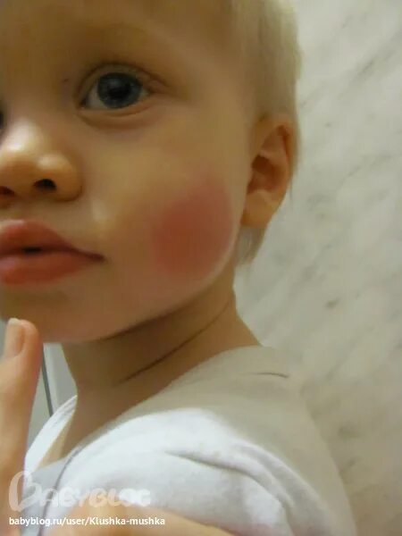 отморожение 1 степени первая помощь. ребенок отморозил щеки что делать. ребенок отморозил щеки что делать. ребенок отморозил щеки что делать. ребенок отморозил щеки что делать.