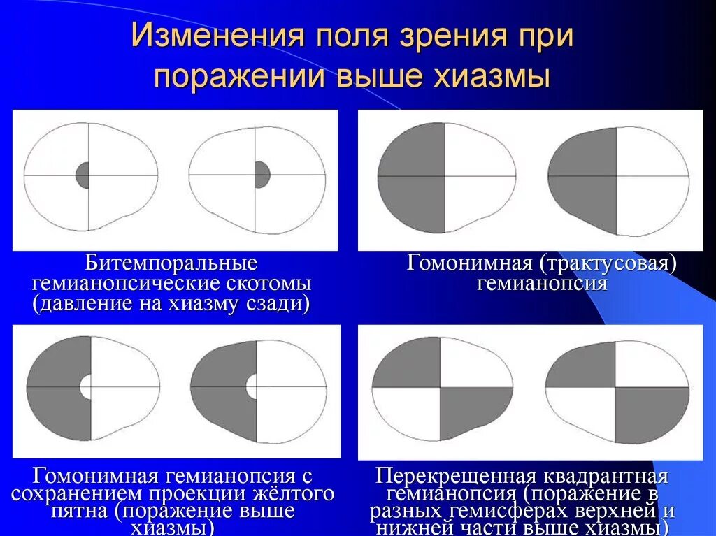 Нижнеквадрантная гемианопсия. Квадрантная гомонимная гемианопсия. Выпадение полей зрения. Изменение полей зрения.