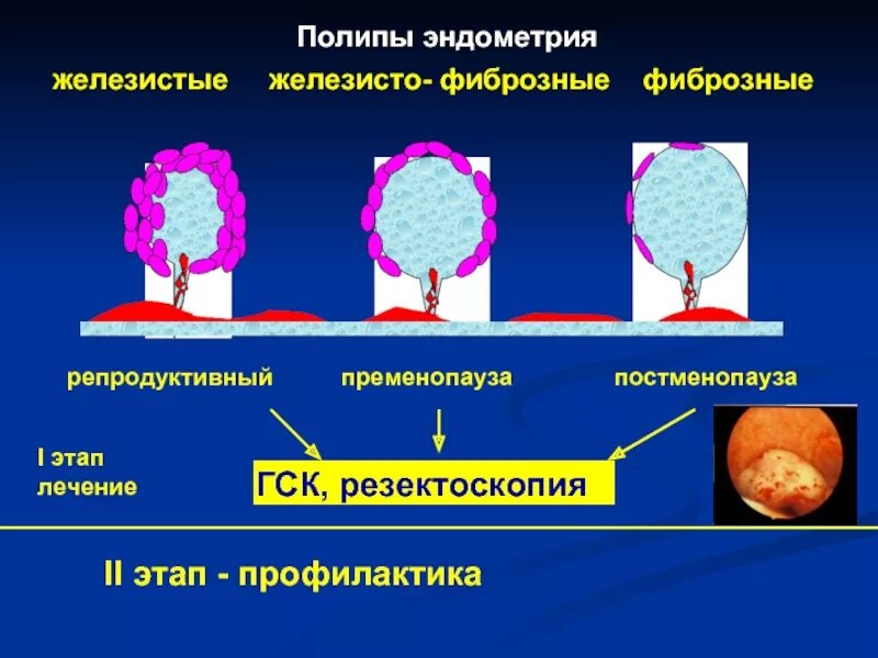 Железистый полип эндометрия. Строение полипа эндометрия. Фиброзный полип эндометрия. Полип в эндометрии матки отзывы