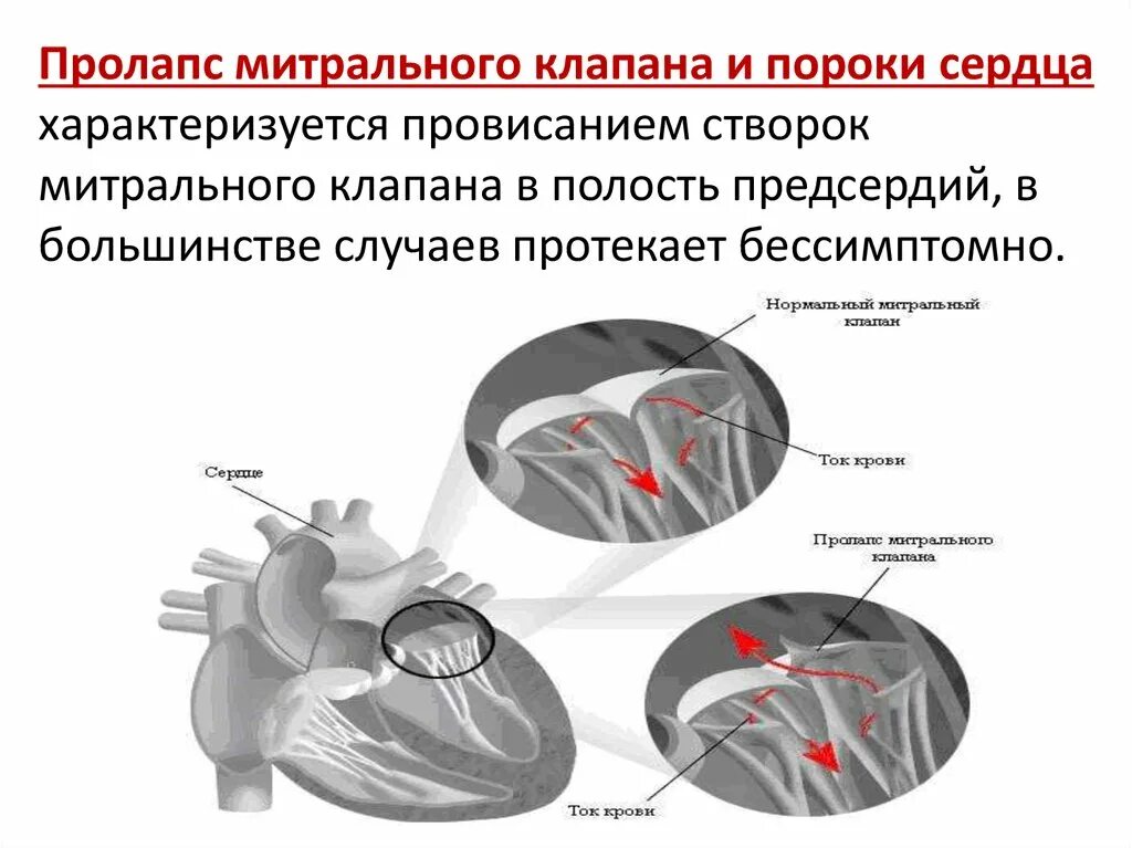 Что такое пролапс митрального клапана. Осцилляция передней створки митрального клапана. Осцилляция передней створки митрального клапана характерна для. Пролапс створки аортального клапана. Пролабирование передней створки митрального клапана.