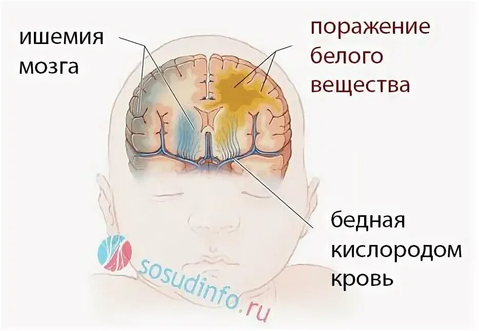 Резидуальное поражение головного мозга. Аноксическое поражение мозга. Аноксическое поражение головного мозга это. Ишемия мозга у новорожденных.