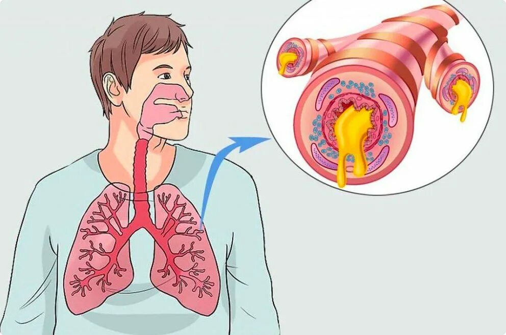 Мокроты после бронхита. Гнойно обструктивный бронхит. Острый и хронический бронхит. Симптомы поражения бронхов. Острый обструктивный Гнойный бронхит.
