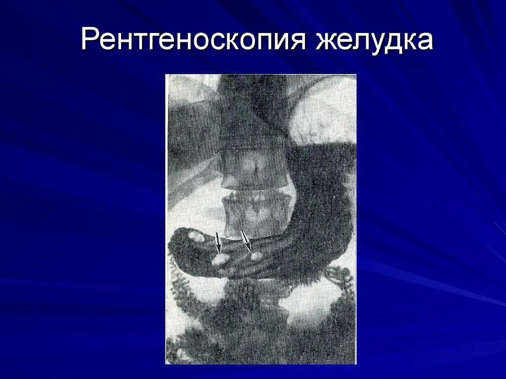 Рентгеноскопия желудка. Рентгенологическое исследование пищевода и желудка. Рентгеноскопическое исследование желудка.