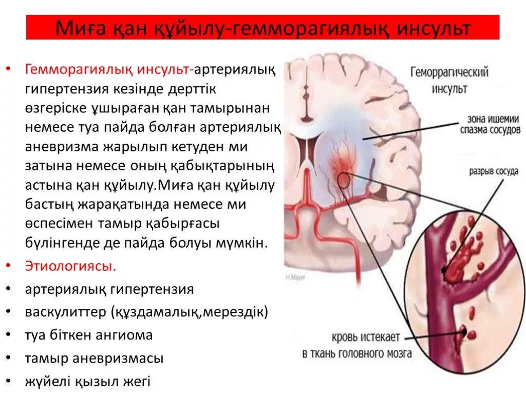 Инсульт органа. Инсульт. Очаг ишемического инсульта. Презентация на тему геморрагический инсульт.