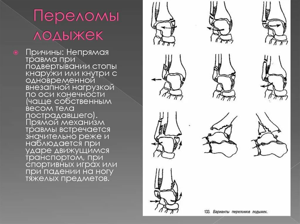 Отрывной перелом позвонка. Остеосинтез лодыжки реабилитация. Перелом наружной лодыжки типа. Классификация перелома дитслального эпифиза большеберцовой кости. Перелом лодыжек типа десто.