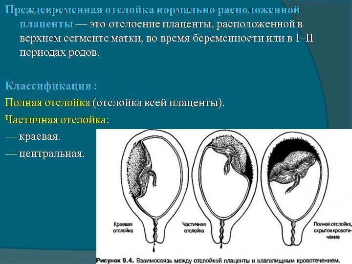 Преждевременно отслойка плаценты. Преждевременная отслойка нормально расположенной плаценты симптомы. Отслойка нормальной плаценты. Отслойка нормальной плаценты. Отслойка нормально расположенной плаценты.