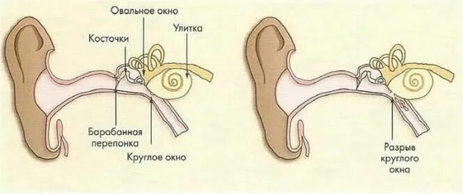 Баротравма барабанной перепонки. Отит барабанная перепонка лопнула. Ухо разрыв барабанного перепонка. Искривление барабанной перепонки. Баротравма это простыми словами в медицине