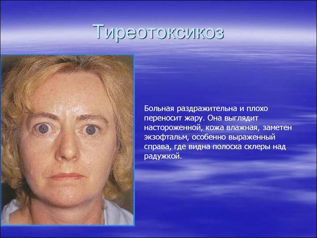 Гипертиреоз dr md ru. Тиреотоксикоз щитовидной железы симптомы. Тиреотоксикоз щитовидной железы что это такое у женщин. Эрготоксикоз это. Осложнения базедовой болезни.