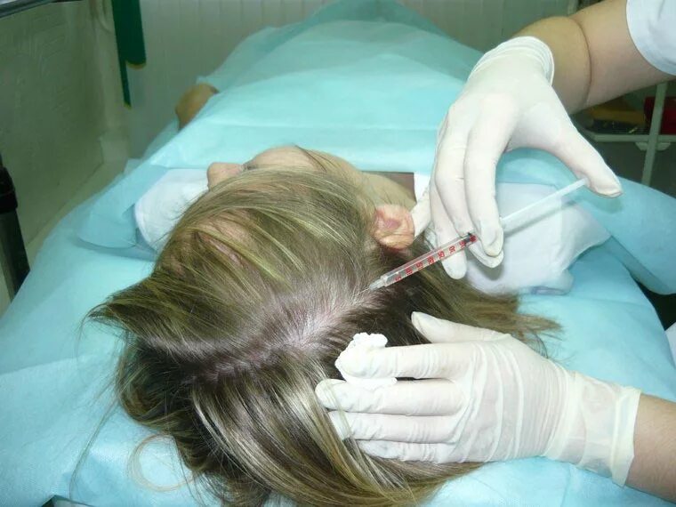 Инъекции головы. Мезотерапия головы. Мезотерапия для волос. Мезотерапия для кожи головы и волос. Мезонити для волосистой части головы.