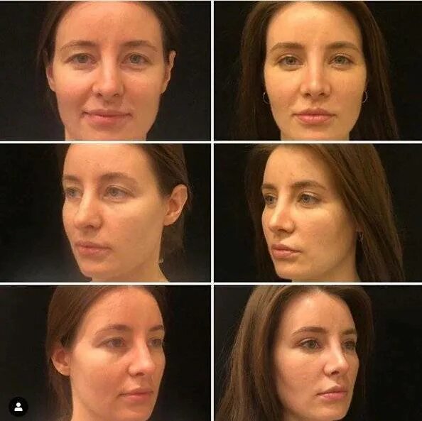 Ринопластика александра мошкалова. Ринопластика носа в новосибирске. Открытая и закрытая ринопластика. До и после блефаропластики и ринопластики. Ринопластика и блефаропластика.