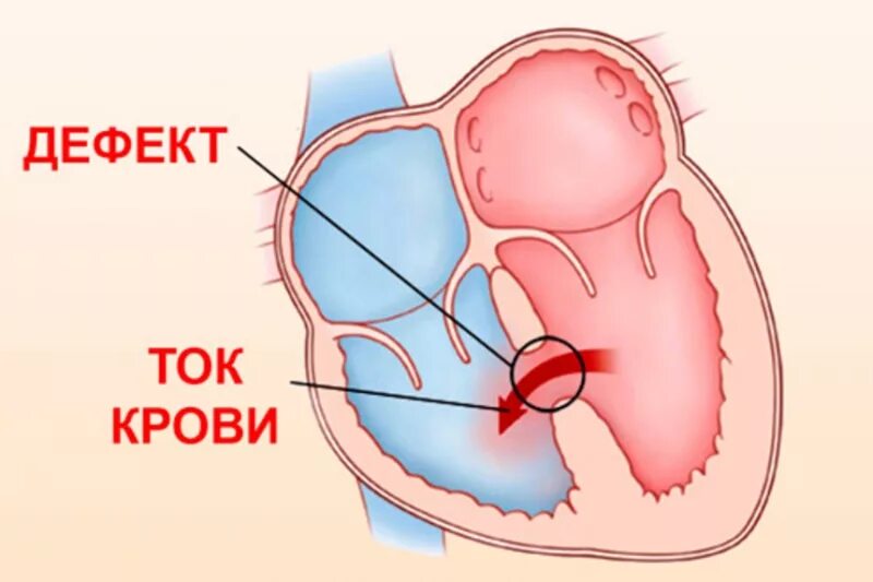 Врожденные пороки сердца дефект межжелудочковой перегородки(дмжп). Мышечный дефект межжелудочковой перегородки. Субтрикуспидальный дефект межжелудочковой перегородки. Дефект межпредсердной перегородки (дмпп). Дефект межжелудочковой перегородки сердца плода.