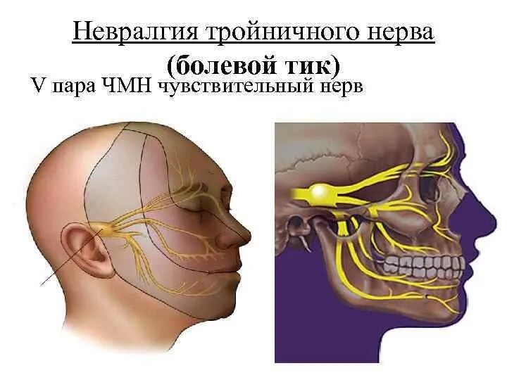 Поражение ветвей тройничного нерва. Невралгия тройничного нерва синдромы. Клиника поражения тройничного нерва неврология. Неврология 3 ветви тройничного нерва.