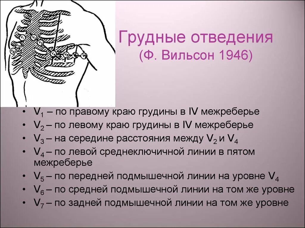 Расположение 6 грудных электродов. Грудные отведения ЭКГ. Грудные отведения по Вильсону. Грудные отведенря потвильсону. Правые грудные отведения