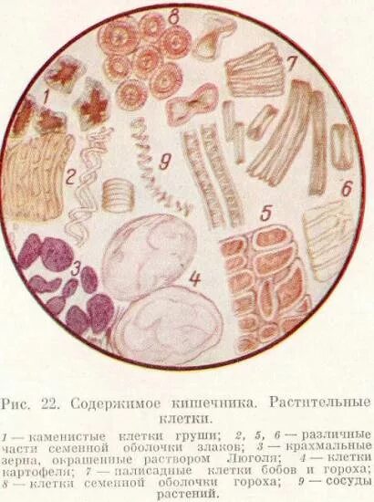 Копрология кала микроскопия лейкоциты. Микроскопия кала атлас клетчатка. Микроскопия кала атлас копрология. Микроскопия нативного препарата кала. Перевариваемая растительная клетчатка в кале у ребенка