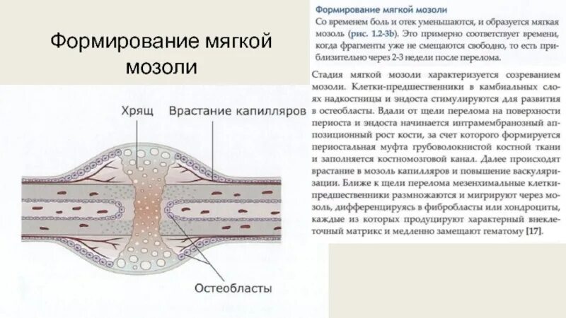 Образование костной мозоли при переломе. Формирование костной Манхони. Формирование костной мозоли. Формируется костная мозоль.