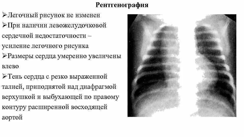 Левожелудочковая недостаточность на рентгенограмме. Рентгенография при левожелудочковой ХСН. Усиление легочного рисунка. Легочный рисунок усилен.