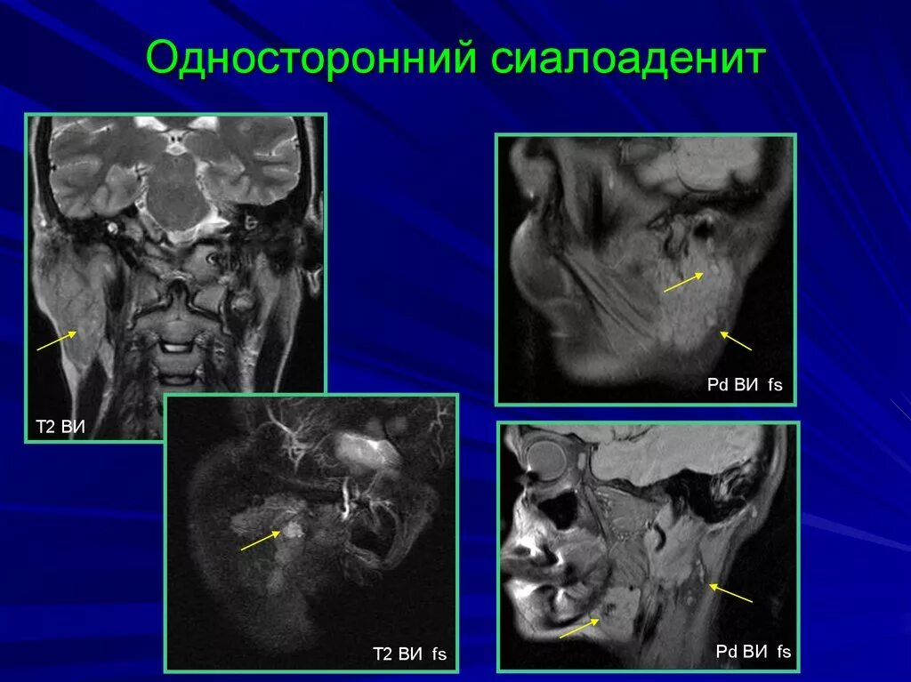 Околоушная слюнная железа кт. Киста околоушной слюнной железы кт. Калькулезный сиалоаденит слюнной железы. Острый Гнойный сиалоаденит. Узи околоушных желез