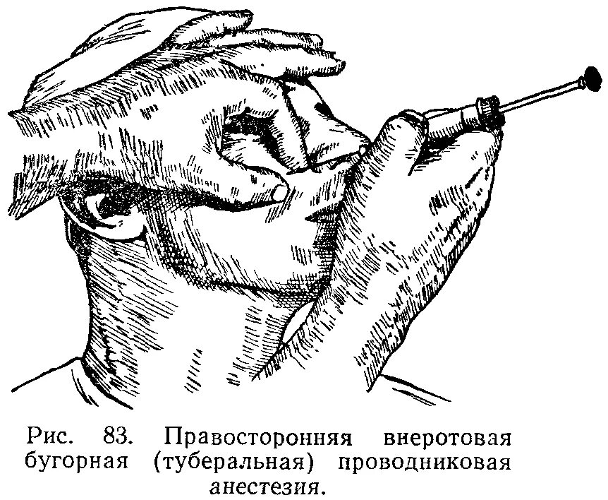 Туберальная проводниковая анестезия. Туберальная анестезия внеротовой метод. Туберальная анестезия верхней челюсти внеротовой мето. Туберальная анестезия по Вайсблату. Что такое проводниковая анестезия