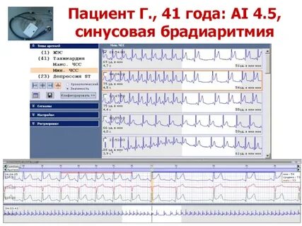 Синусовая брадиаритмия