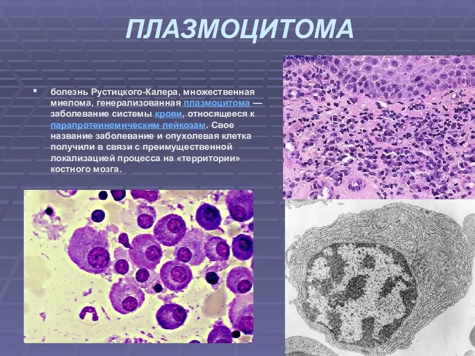 Множественная миелома микропрепарат. Множественная миелома плазматические клетки. Миеломная болезнь гистология. Миеломная болезнь (плазмоцитома).. Опухоль клеток крови