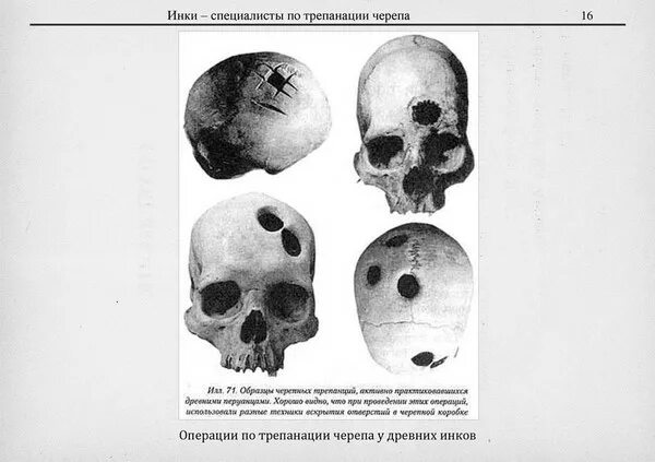 Трепанация черепа в каких случаях