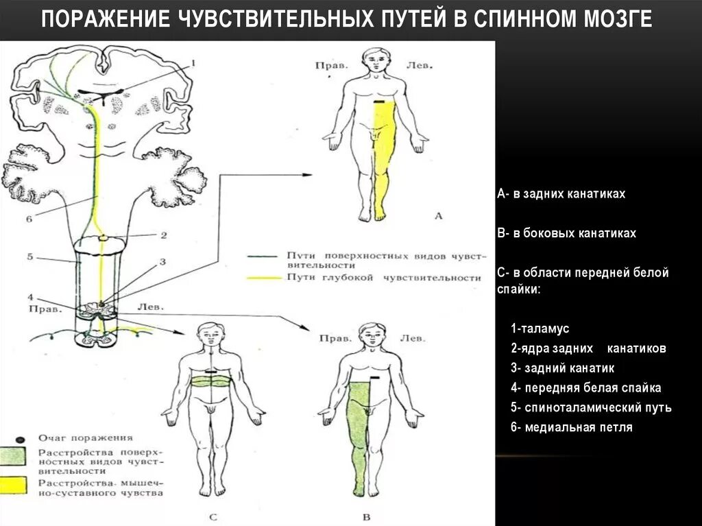 Поражение задних Корешков спинного мозга симптомы. Синдром поражения эпиконуса спинного мозга. Синдром поражения задних канатиков. Симптомы поражения чувствительности.