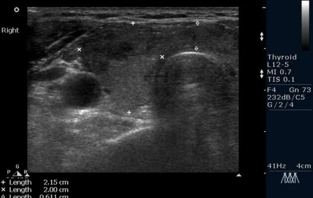 Фокально-диффузных изменений щитовидной железы УЗИ. Инфильтрация щитовидной железы УЗИ. Диффузные изменения щитовидной железы УЗИ. Щитовидная железа изменения на узи