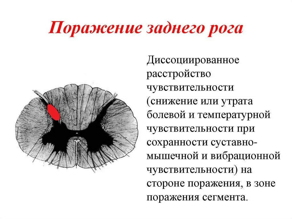 Передние и задние рога сегментов спинного. Синдром поражения заднего рога спинного мозга. Синдром поражения задних канатиков спинного мозга. Симптомокомплекс поражения задних Рогов спинного мозга. Синдром поражения бокового рога спинного мозга.