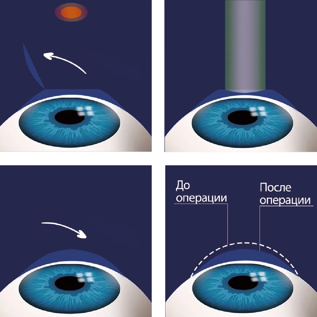Сколько восстанавливается зрение после лазерной. Лазерная коррекция зрения ласик. Л͇а͇з͇е͇р͇н͇а͇я͇к͇о͇р͇е͇к͇ц͇и͇я͇з͇р͇е͇н͇и͇я͇. Минусы лазерной коррекции зрения. Операция лазером на глаза для улучшения зрения.