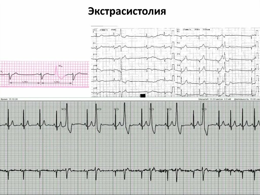 Как вылечить экстрасистолию