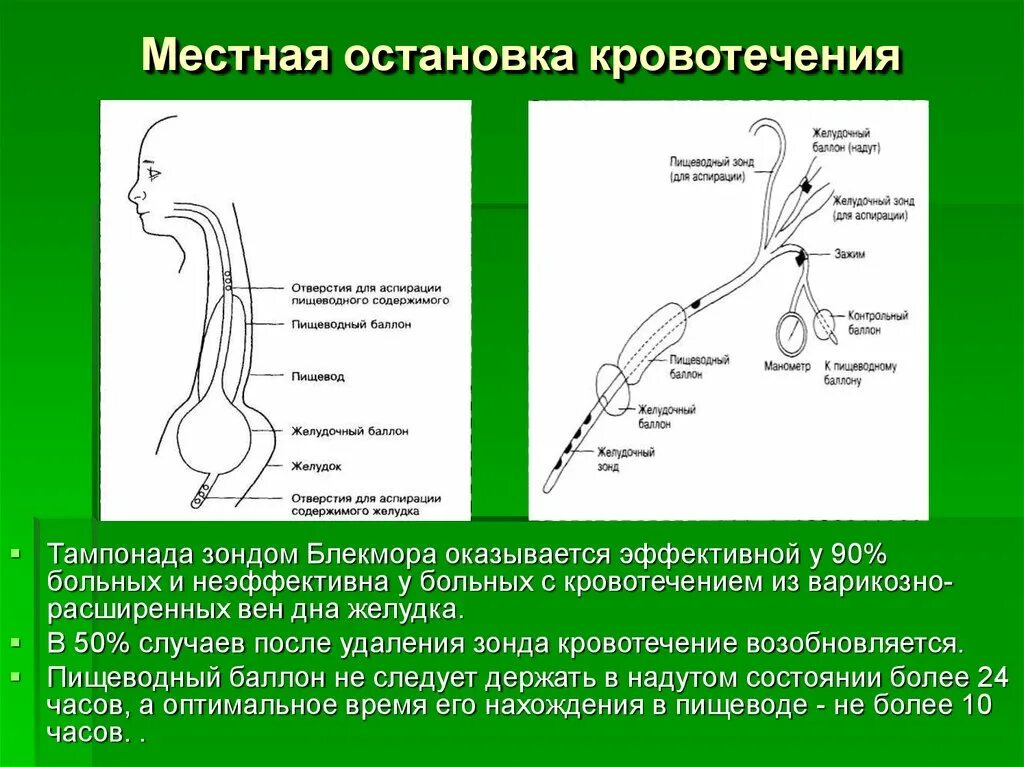 Баллонная тампонада пищевода. Баллонная тампонада зонд Блэкмора. Зонд Блэкмора для остановки. Зонд для остановки желудочного кровотечения.