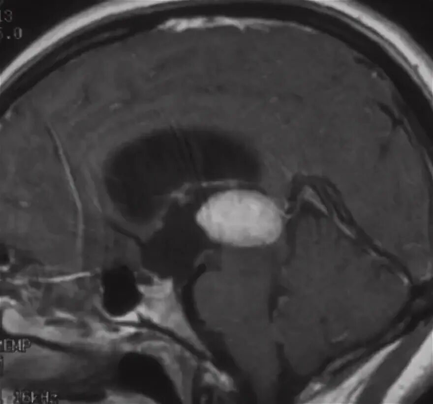 Менингиома крыла основной кости мрт. Менингиома инвалидность. Менингиома инвалидность. Менингиома инвалидность. Гиперостотическая менингиома.