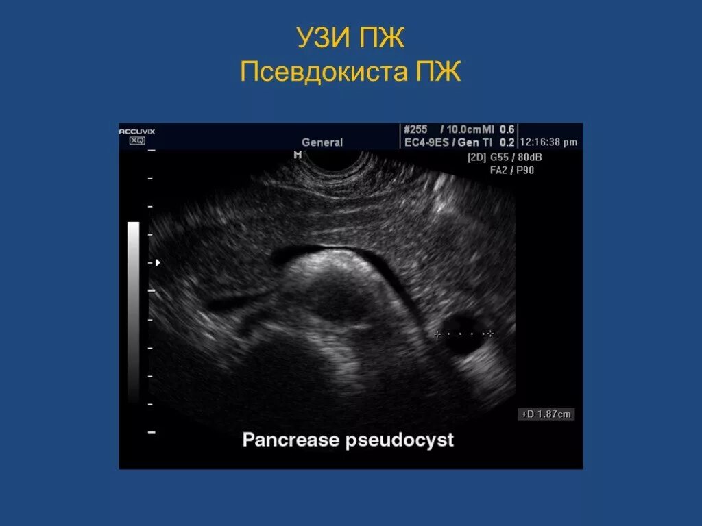 Острый панкреатит эхограммы. Псевдокиста поджелудочной железы на УЗИ. Киста псевдокиста поджелудочная железа УЗИ. Киста поджелудочной железы на УЗИ. На узи видно поджелудочную железу