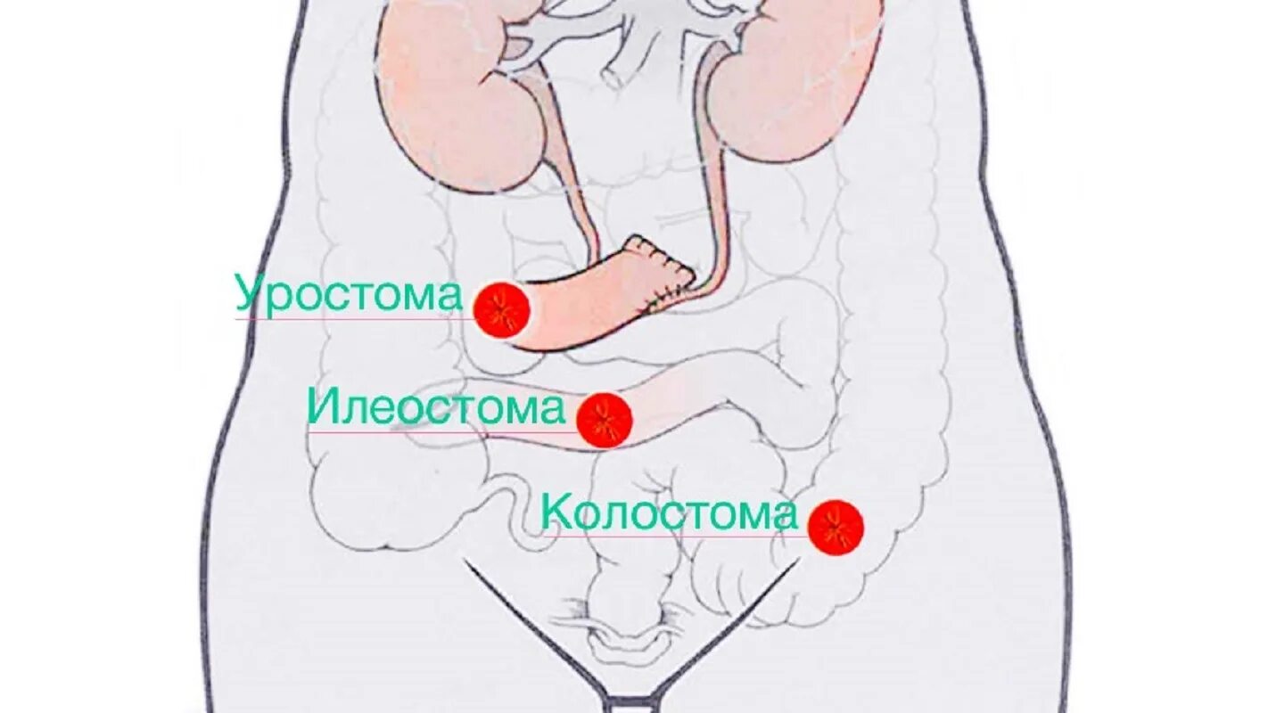 Уход за стомами кишечника. Илеостома алгоритм. Виды калоприемников. Илеостома алгоритм. Илеостома алгоритм.