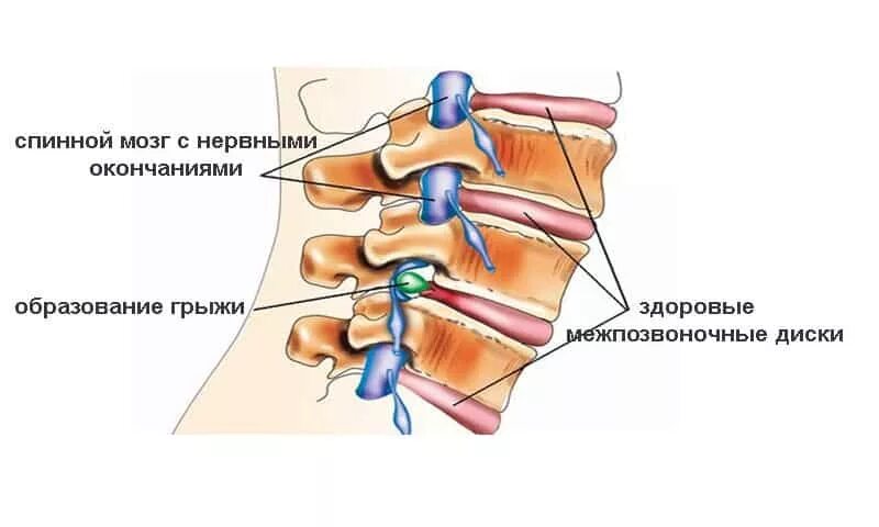 Межпозвонковая грыжа шейного отдела. Грыжа диска шейных позвонков. Грыжа спинного мозга шейного отдела. Грыжа шейного отдела позвоночника схема.