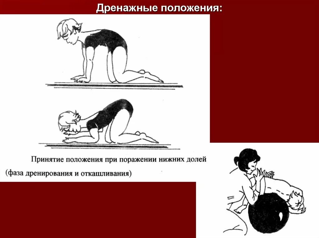 Дренажное положение. Дренажное положение при пневмонии. виды дренажных положений. положение квинке это дренажное положение.