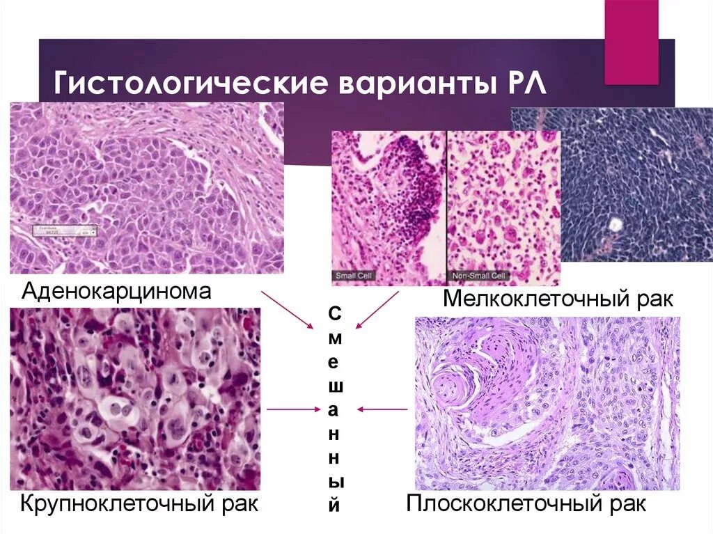 Аденокарцинома кишечника гистология. Карциноид желудка гистология. Ацинарная аденокарцинома гистология. Аденокарцинома Толстого кишечника гистология. Низкодифференцированный плоскоклеточный рак