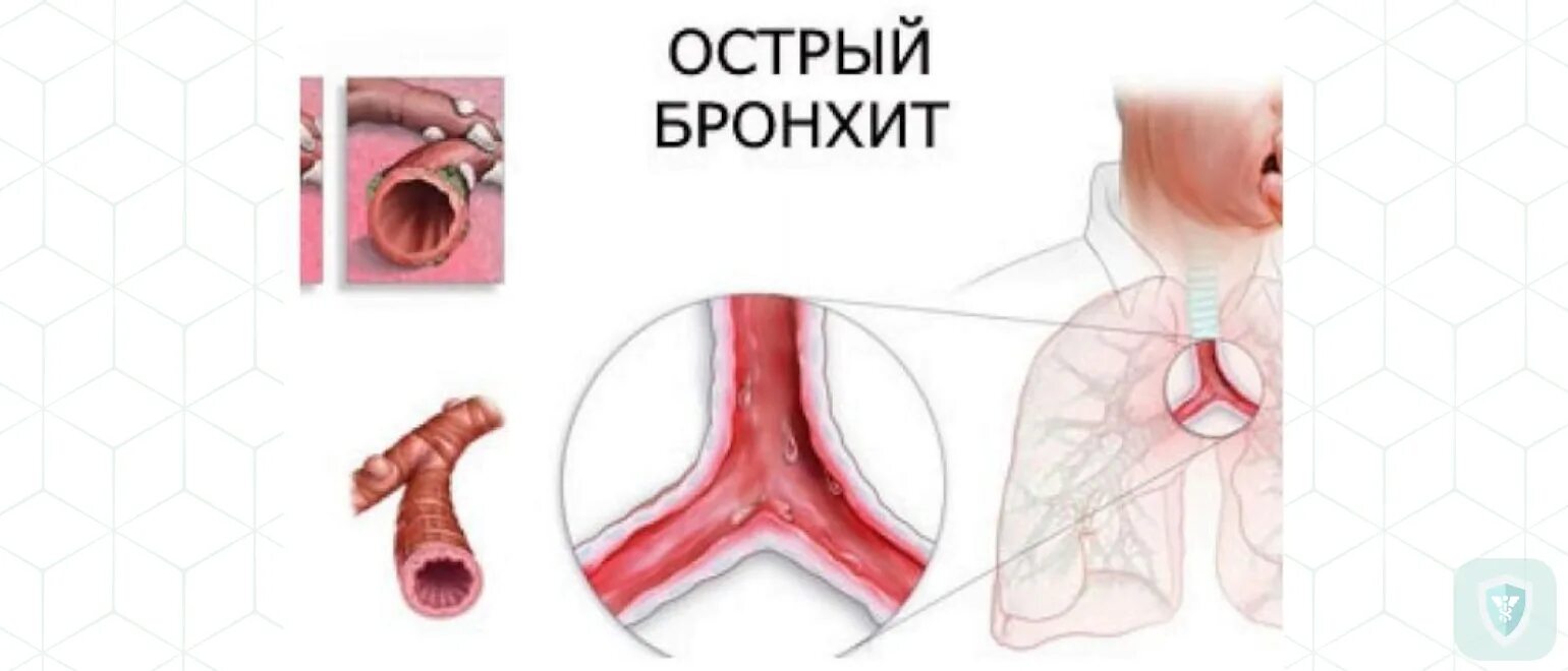 Острый и хронический бронхит симптомы. Острый бронхит с поражением крупных бронхов. Остры й хроничесуи й бронизт.