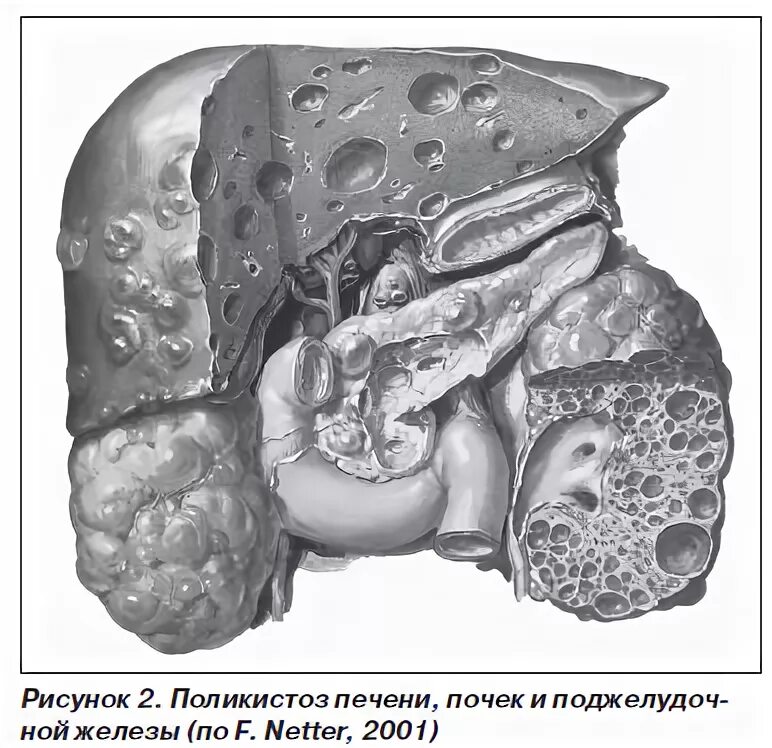 Железы печени и почек. Поликистоз печени цирроз печени. Поликистоз поджелудочной железы. Поликистоз печени и почек.