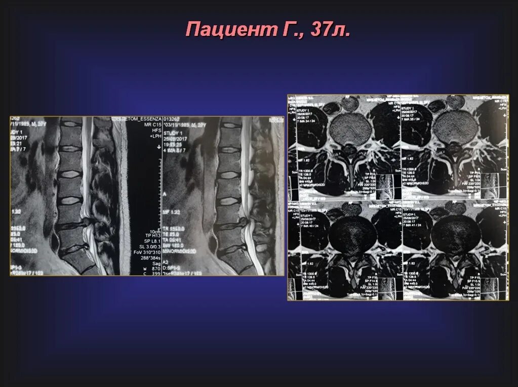 Операция по замене позвоночника. Имплант межпозвонкового диска. Имплант межпозвоночного диска поясничного отдела. Замена межпозвонкового диска поясничного отдела. Имплант диска позвоночника поясничного отдела.