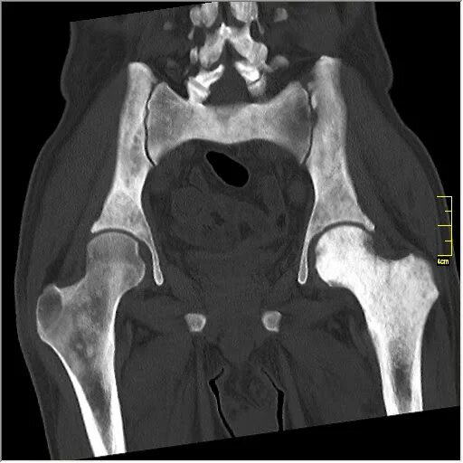 Остеосклероз тазобедренного. Остеосклероз на кт. Диффузный остеосклероз кт. Пятнистый остеосклероз. Очаговый остеосклероз кт.