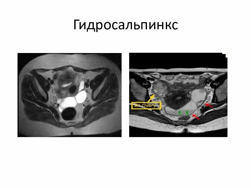 Мрт малого таза гидросальпинкс. Трубы маточные гидросальпинкс мрт. Гидросальпинкс этиология. Гидросальпинкс лечение операции