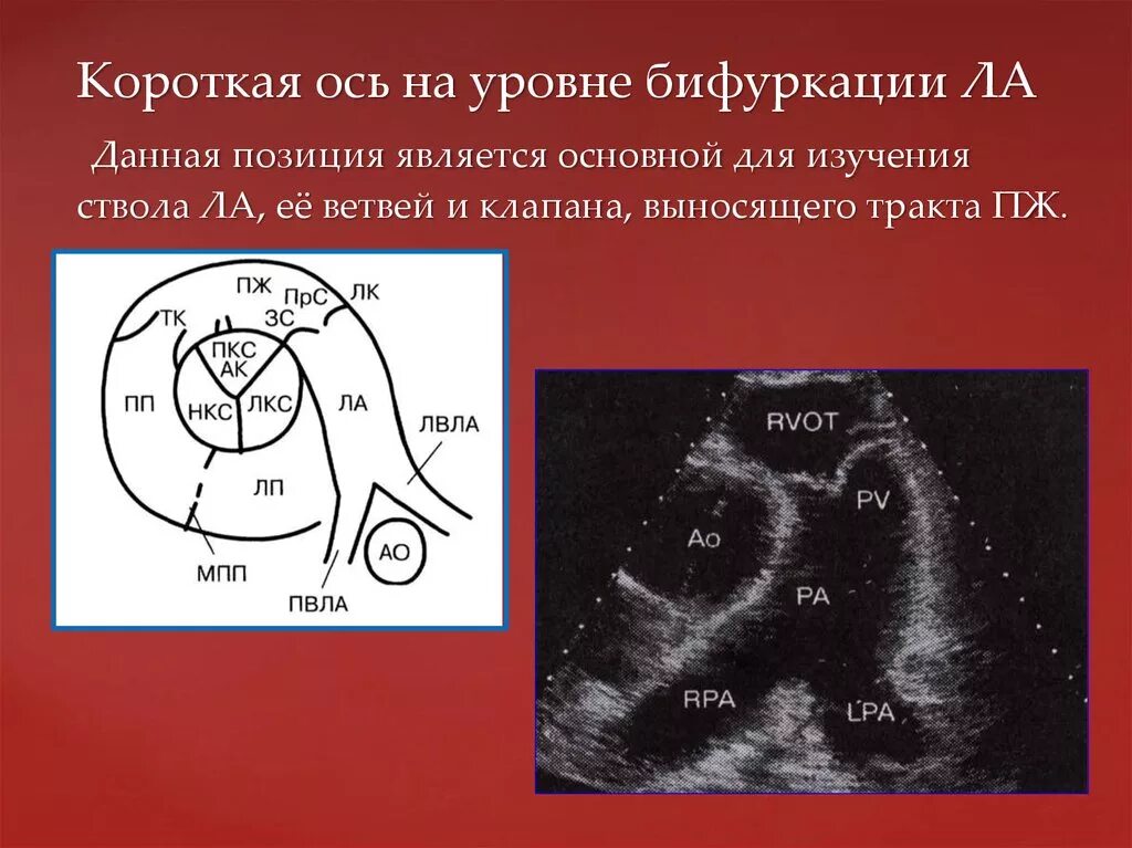 Эхо кратчайшее содержание. Узи анатомия створок аортального клапана. клапан легочной артерии на эхокг. коронарная фистула на эхокг. ветви легочной артерии на узи.