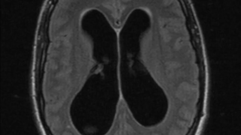 Нормотензивная гидроцефалия мрт. Гидроцефалия головного мозга мрт. Наружная гидроцефалия мрт. Нормотензивная гидроцефалия кт.