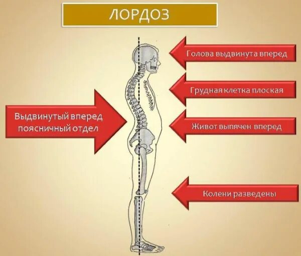 Лордоз поясничного отдела гимнастика. Что такое лордоз позвоночника поясничного. Лордоз поясничного отдела упражнения. Поясничный лордоз упражнения.