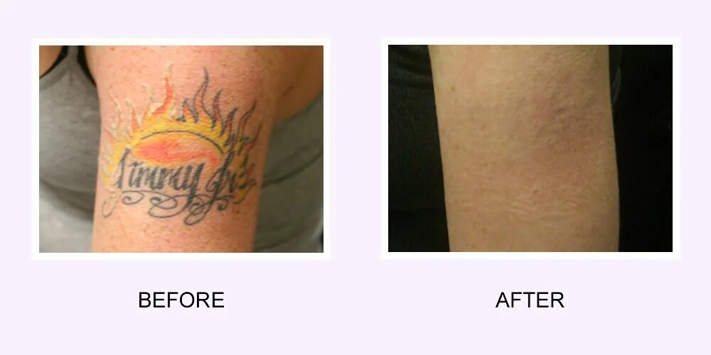 Выведение татуировок лазером. Сведенные Татуировки до и после. Свести цветную татуировку лазером. Сдать кровь после тату
