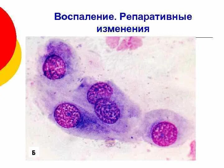 Часть клеток с реактивными изменениями. Репаративные изменения в цитологии. Репаративные изменения в цитологии шейки матки. Репаративные изменения клеток. Реактивно репаративные изменения.