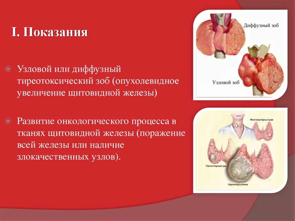 Диффузно одноузловой зоб. Многоузловой диффузный зоб щитовидной железы. Узловой и многоузловой зоб. Многоузловой диффузный