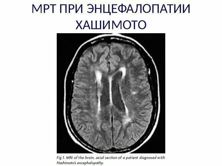 Резидуальные очаги головного мозга. Энцефалит головного мозга кт. Энцефалопатия головного мозга на кт. Дисциркуляторная энцефалопатия на кт. Резидуальная энцефалопатия кт.